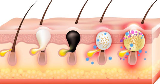 Advanced Acne Wellness Plan